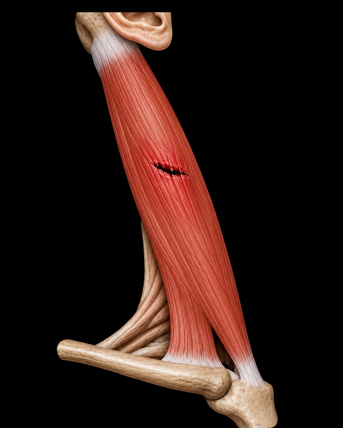Spine module preview — Sternocleidomastoid Tear