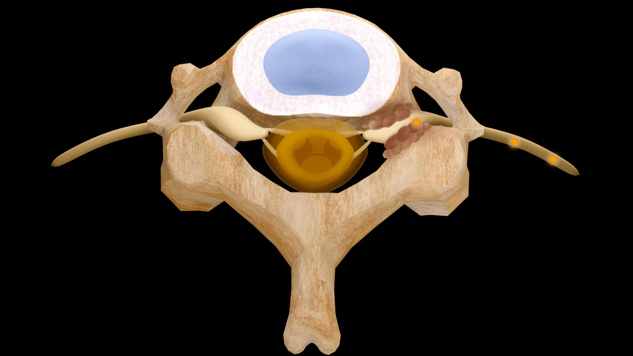 Right Lateral Stenosis — Moderate