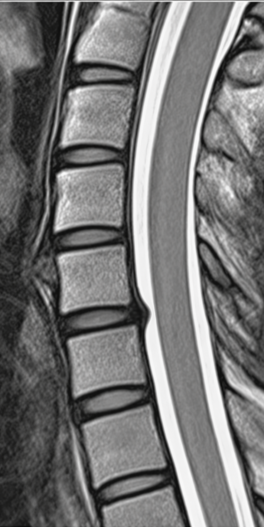 Cervical Disc Herniation — Moderate
