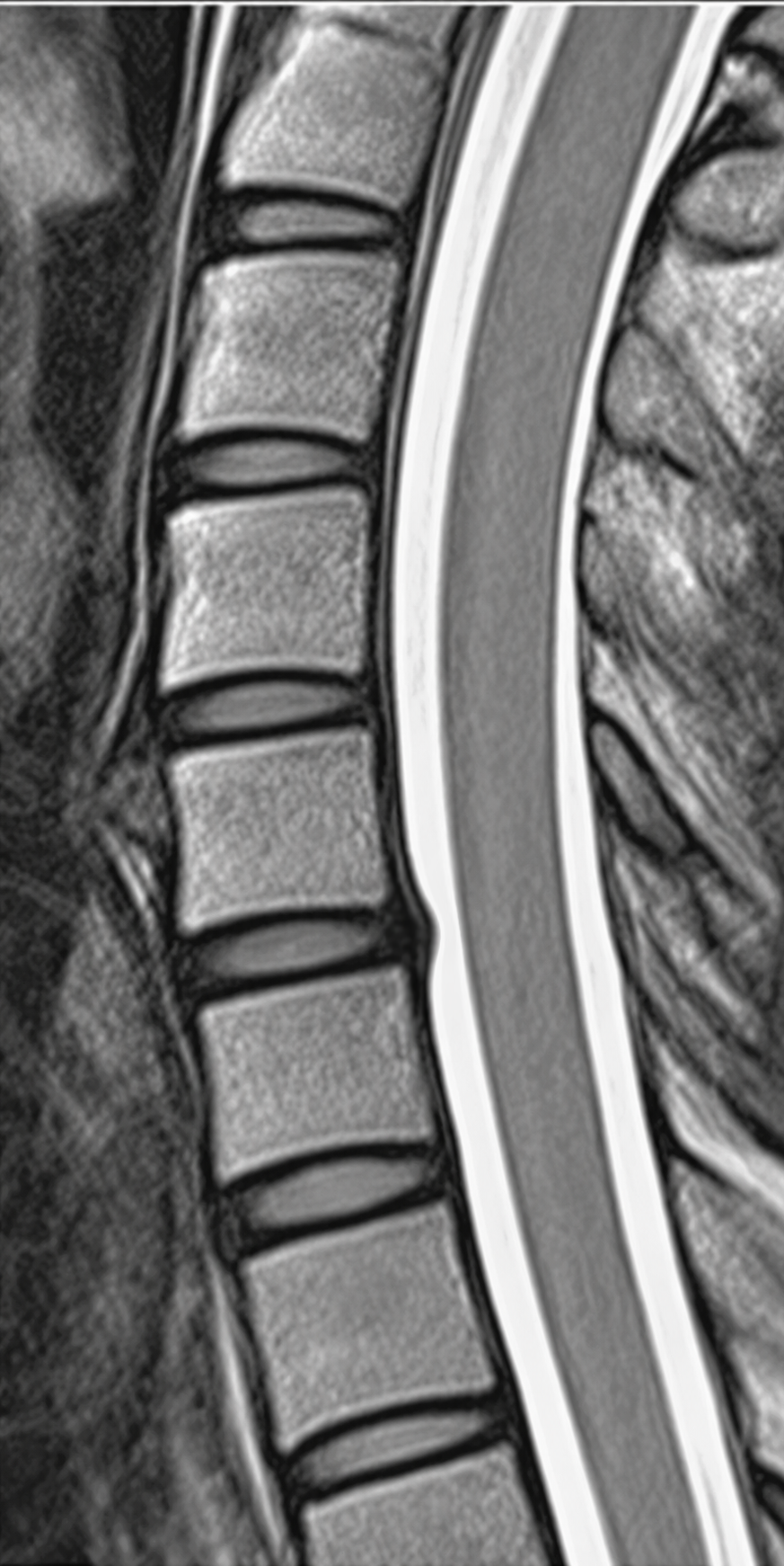 Cervical Disc Herniation — Mild