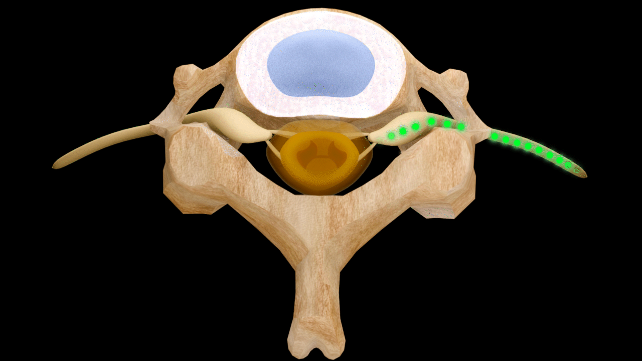 Right Lateral Stenosis — Normal