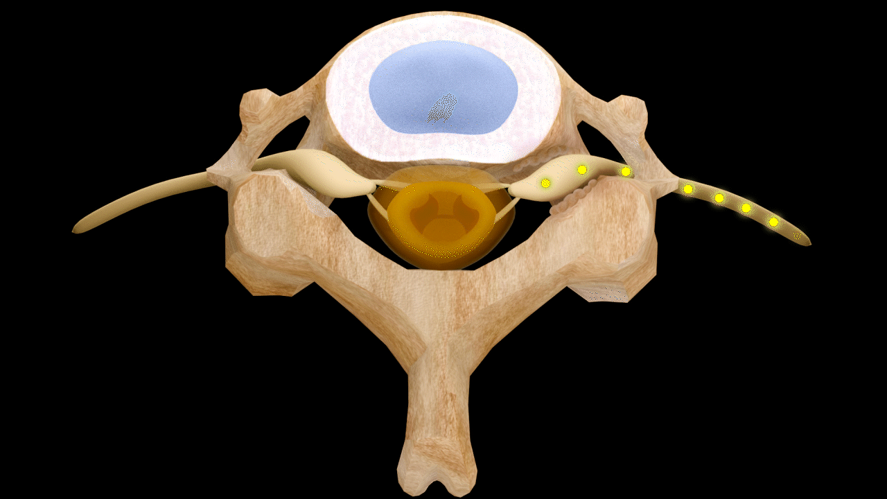 Right Lateral Stenosis — Mild