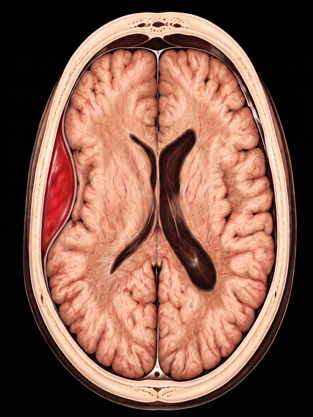Advanced Personal Injury module preview — Epidural Hematoma Progression (CT)