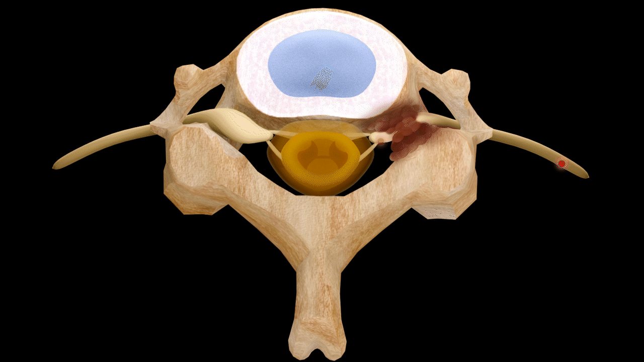 Right Lateral Stenosis — Severe